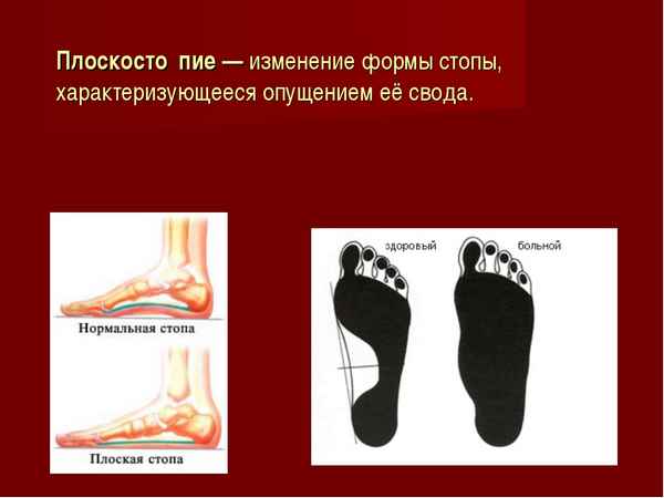 
    Урок биологии по теме "Нарушения осанки и плоскостопие". 8-й класс

      